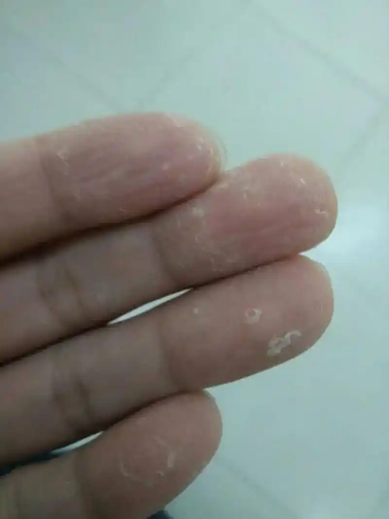 手指总脱皮? 缺维生素or皮肤病?