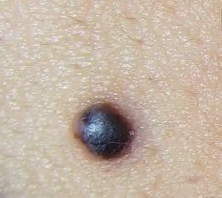 去色素痣不留疤的措施_色素痣