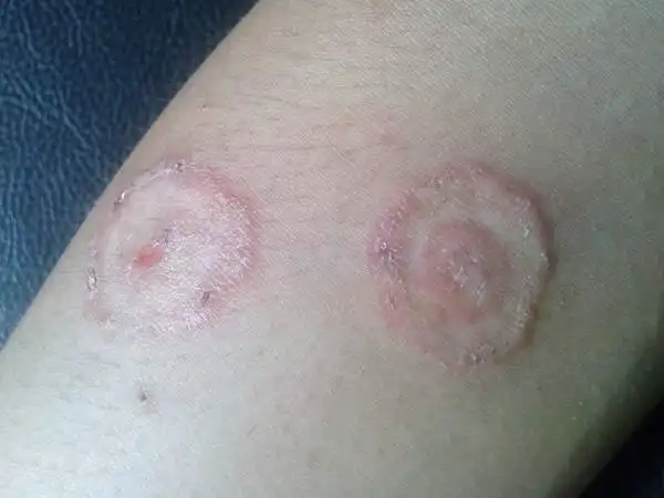 儿童患体癣要怎么护理_体股癣_北京京城皮肤病医院(北京医保定点机构)