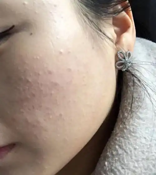 脸上长了好多闭口粉刺!求姐妹们出出招 怎么去除?