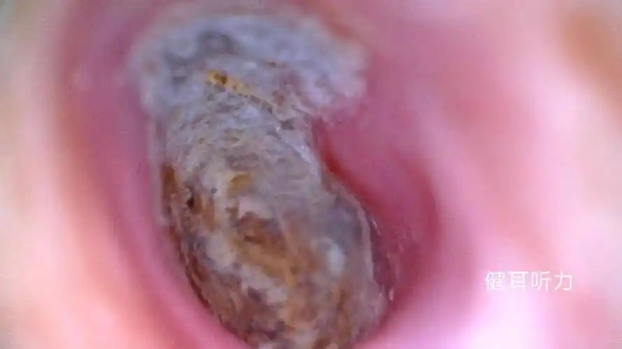 胆脂瘤型:比较严重,持续时间很长,脓比较少,鼓膜的穿孔被痂皮所堵时