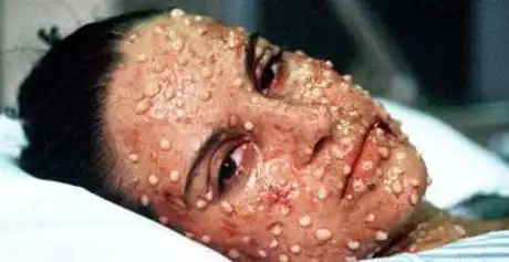 smallpox 2002 - silent weapon