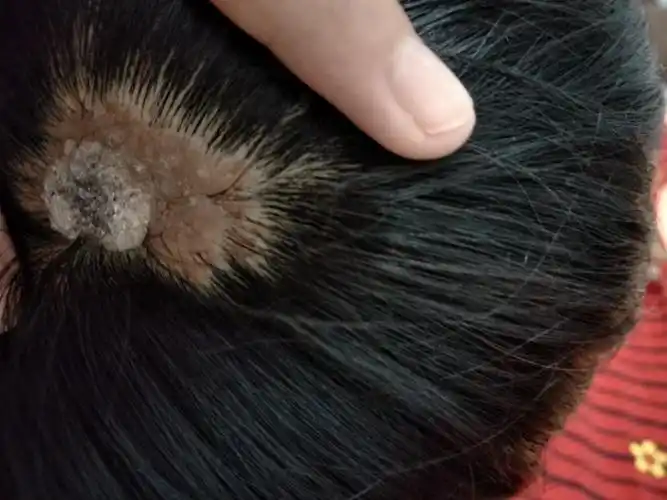 头上一片没头发经大家会诊皮脂腺痣争做良医815