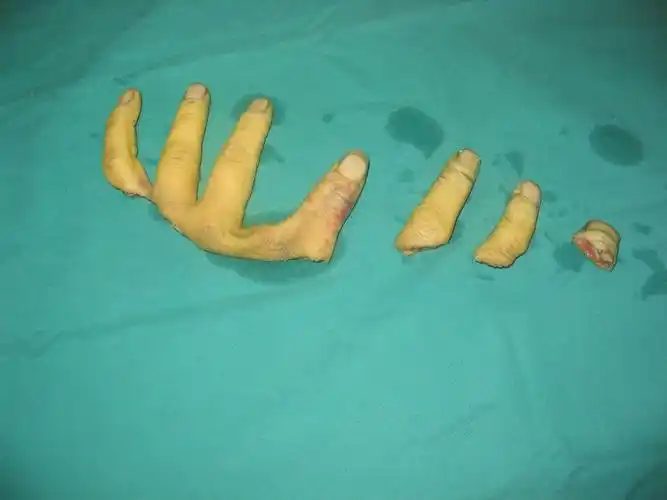 断肢(指)再植 - 好大夫在线