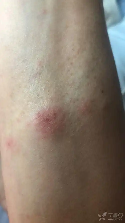 女性30岁,全身小皮疹,求教!