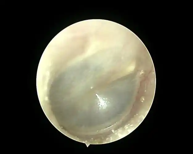 什么情况耳膜会破?破损后有哪些表现?