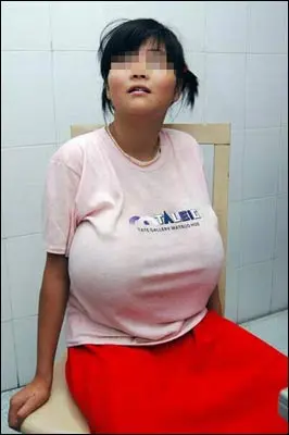 12岁女孩双乳大如足球 开刀切除8公斤组织(图)