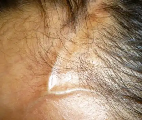 硬皮病头部早期症状