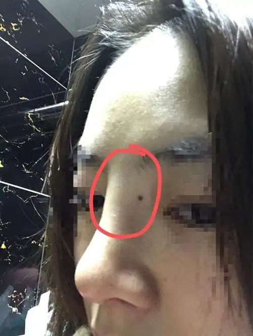 膨体隆鼻快20天了,山根肿,右侧肿有鼓包,_圈子-新氧美容整形