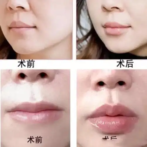 嘟嘟唇到底要不要打?