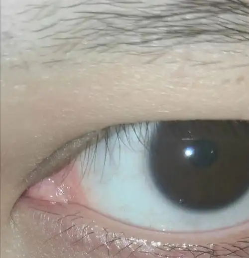 内有图慎入,请问姐妹们这算倒睫吗