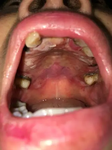 您的口腔黏膜是这样吗? - 好大夫在线