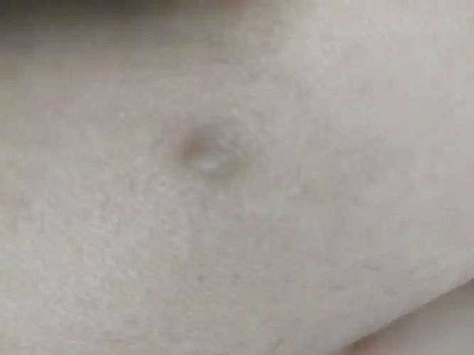 那个环节出现点小毛病,气血循环不好,造成目部皮肤下出现一个小囊肿