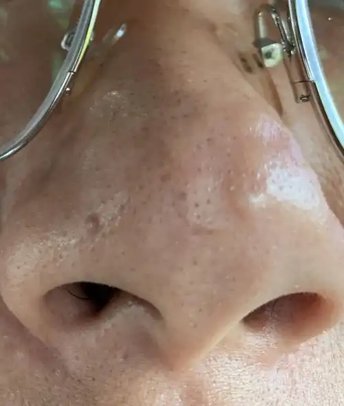 现在痊愈以后鼻头一个一个的大包,一年多了下不去,这个已经属于增生了