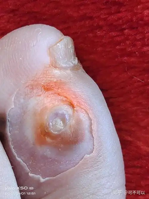 第一次长鸡眼 - 知乎