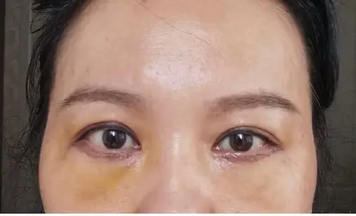 外切眼袋 眶隔释放术后【1个月】恢复完整记录!多图!