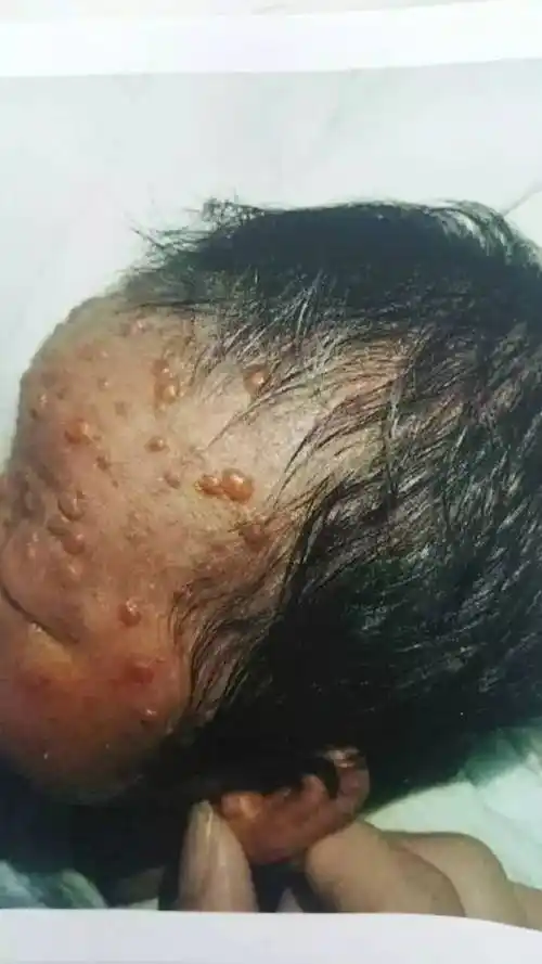 刚刚出生15天的小女孩,弱小的身体起满了脓疱疮(又名"传染性脓疱病"