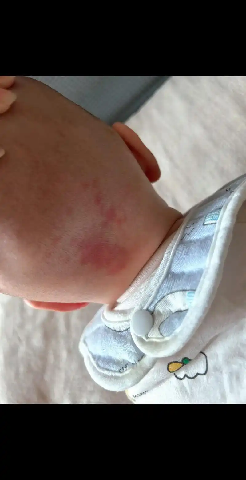 一直以为它只是一个胎记原来它有个好听的名字叫"鹤吻痕",又称 - 抖音