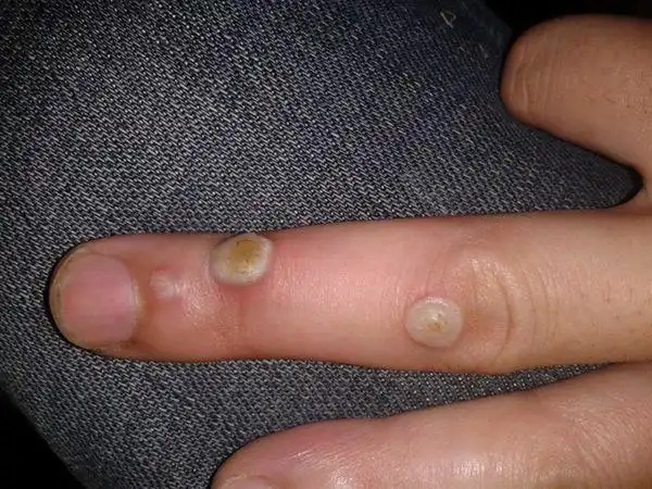 手上长了好几个寻常疣,该怎么去除?最好不要激光