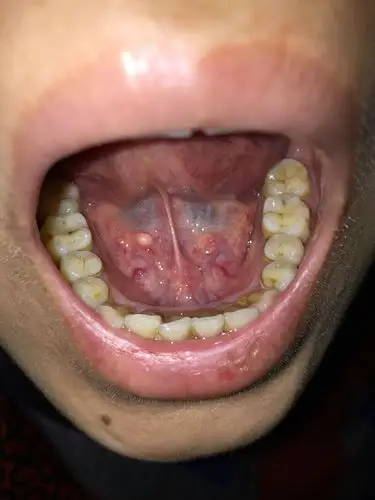 我老婆舌头上长这些是什么病啊?好急