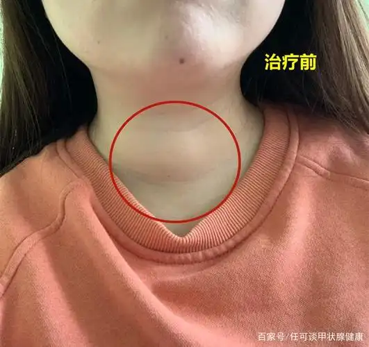 45岁林女士短短时间甲状腺结节降级看看她是怎么做的