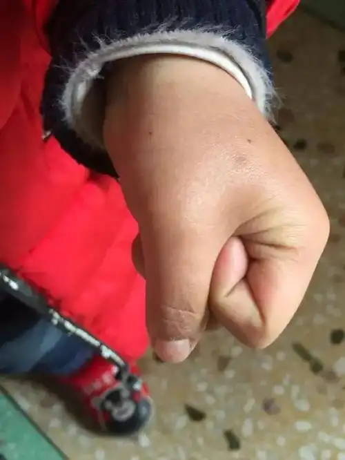 输液后的手部针眼图片-图片大观-奇异网