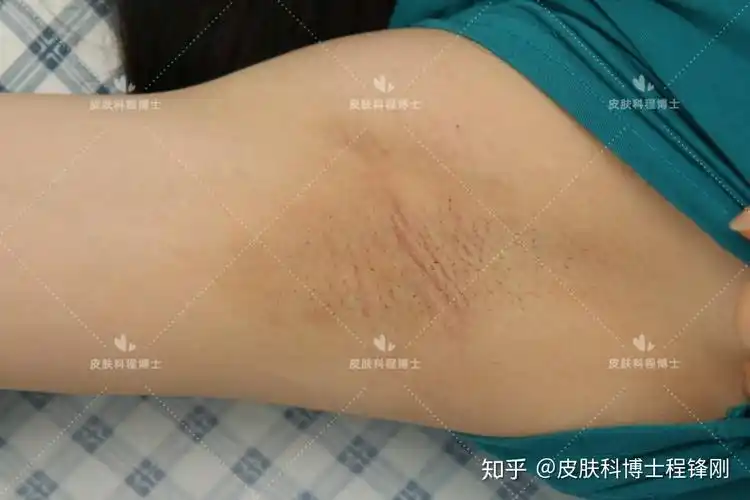 22岁女生双侧腋下狐臭严重案例10