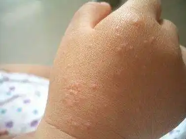 杭州4个月男婴一夜间手肿的像馒头家长注意这个病开始冒头了