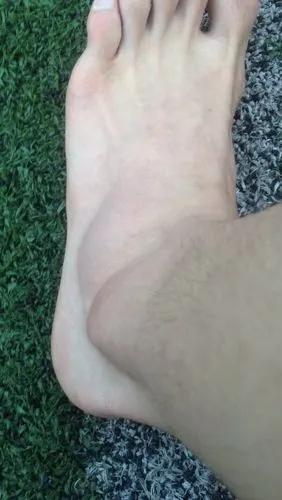 问:昨天打篮球把脚给崴了,脚踝外侧肿了很大一团.