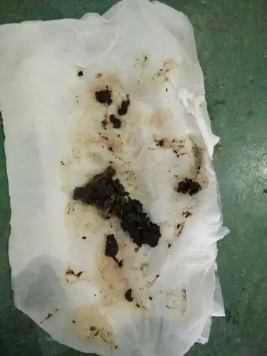 后下面排出一些类似于肉的东西请问妇科用药会排出类似于肉一样内膜吗