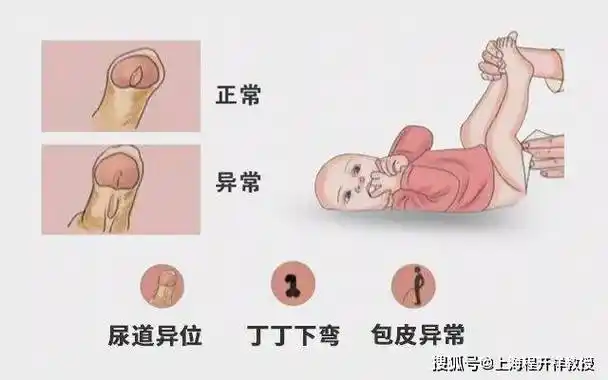 家长可以根据这些特点,仔细观察孩子的尿道口,丁丁形态以及包皮,尿流