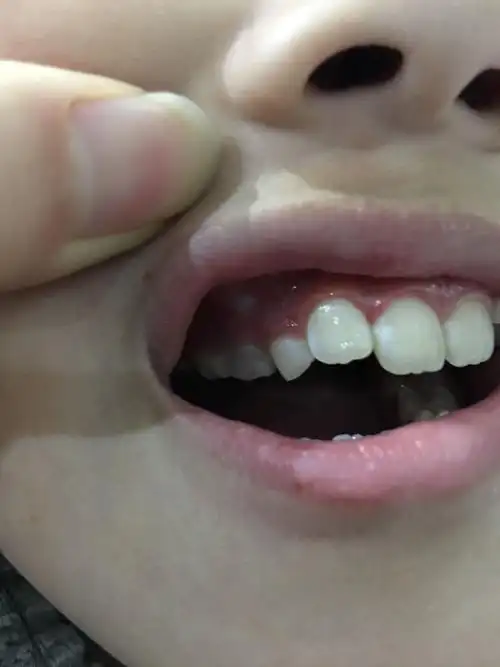 宝宝多久牙齿出来怎么办啊宝宝牙齿多久长好一颗