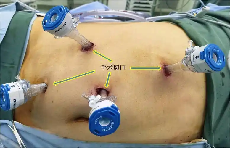 输尿管癌微创手术过程中"不为人知"的致命风险(一例高难度腹腔镜肾输