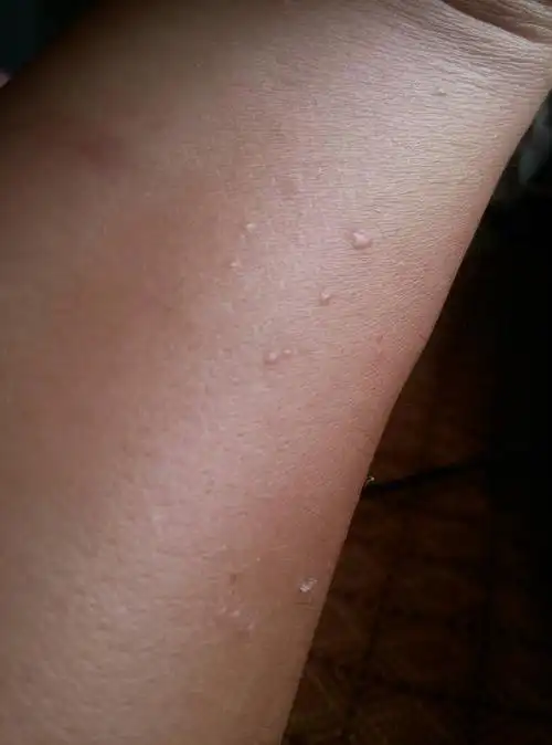 问:胳膊上长了几个扁平疣怎么办?