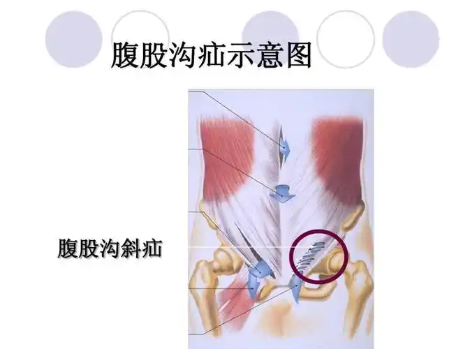 斜疝以婴幼儿及老年人发病率最高.手术治疗是腹股沟疝常用的治疗方法.