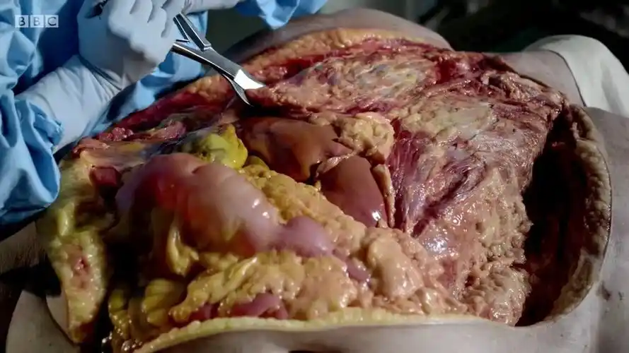 法医是如何解剖尸体的呢法医尸体解剖全过程解密