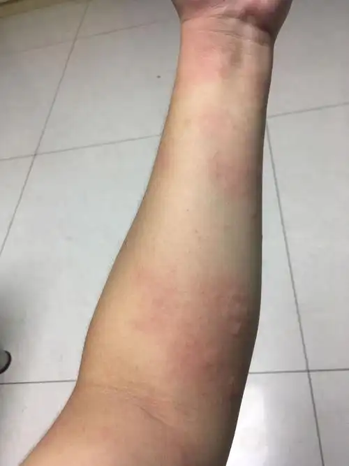 身上起了很多这种包,是跳蚤咬的还是皮肤过敏?