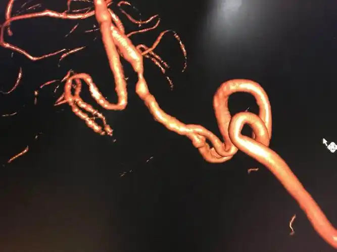 两例椎动脉v4段支架