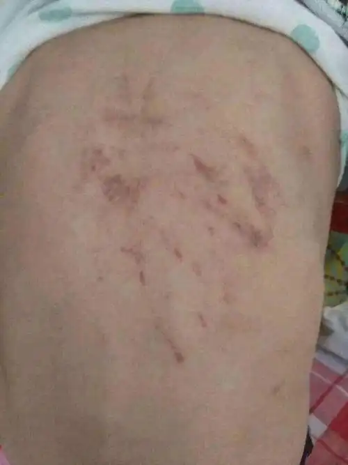 辽宁10岁女孩被继母打得满身伤伤痕触目惊心