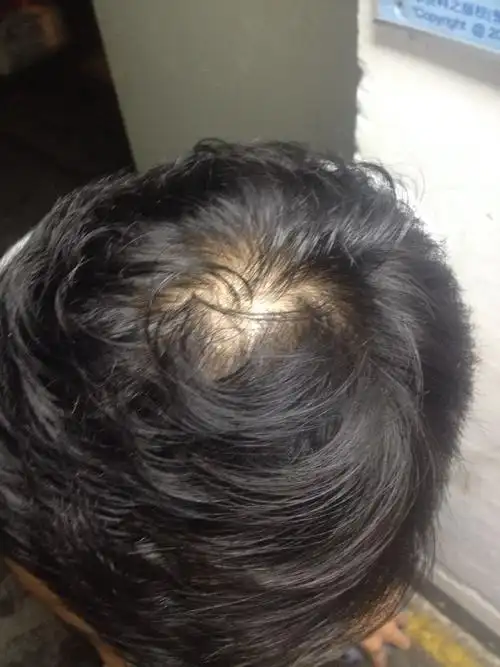 年龄31岁,男,脱发严重,每次洗头都掉很多头发,持续了两年,现在头顶的