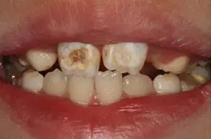 孩子虫牙引发牙齿疼痛该怎么办