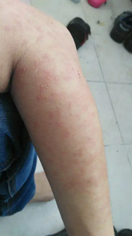 胳膊皮肤变红 毛孔上起个小疙瘩 有点痒