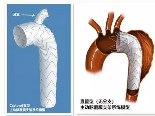 拆弹专家再出新招castor分支支架治疗胸主动脉夹层