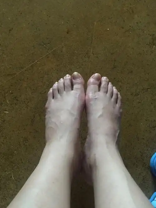 脚背有血管突起,请问这是静脉曲张吗?