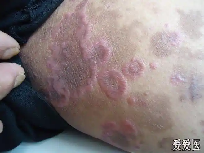 皮肤版"u盘奖励典型病例006:环状扁平苔藓"