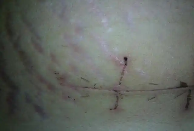 剖腹产手术后刀口会给女性造成哪些伤害大夫说出了心里话