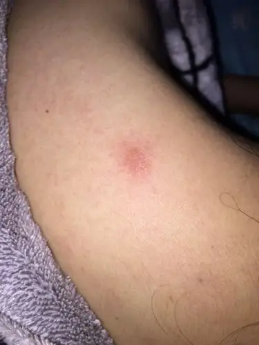 我想问问这个红疹是牛皮癣吗?