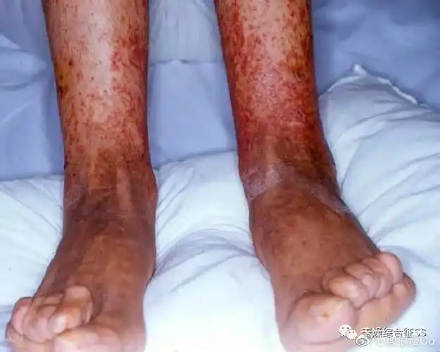 干燥症也是会死人的