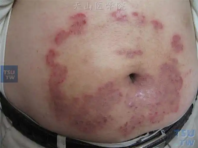 腹部环形红斑,丘疹,边界尚清,部分皮损轻度苔藓化
