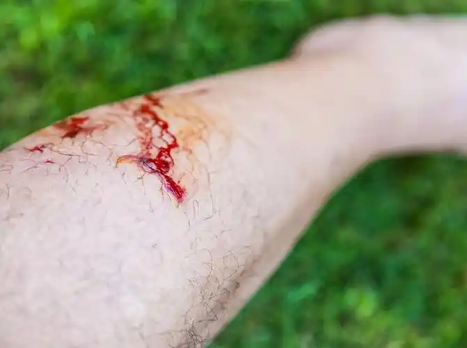 被狗咬伤,记住这三招,处理伤口!感染狂犬病后,有哪些表现?